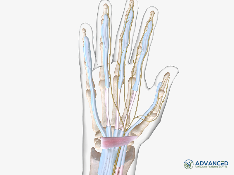 Carpal Tunnel Syndrome Wrist Pain