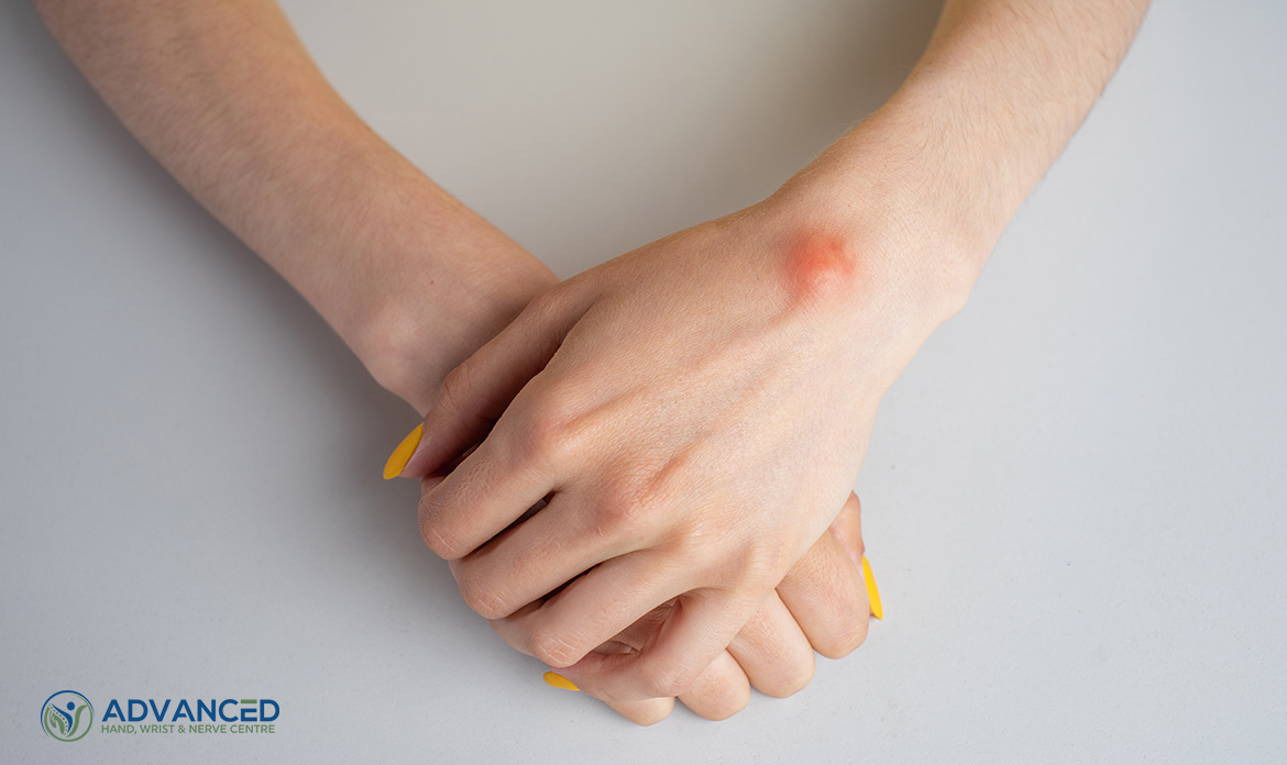 Image Debunking 5 Misconceptions About Ganglion Cysts