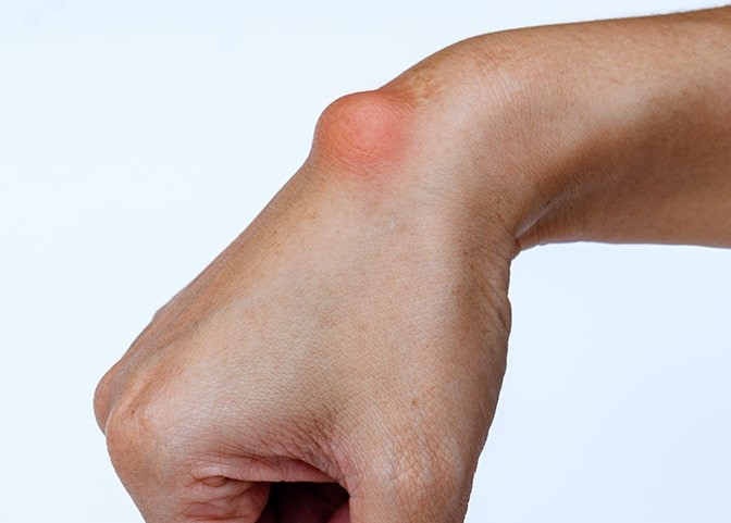Ganglion Cysts Singapore
