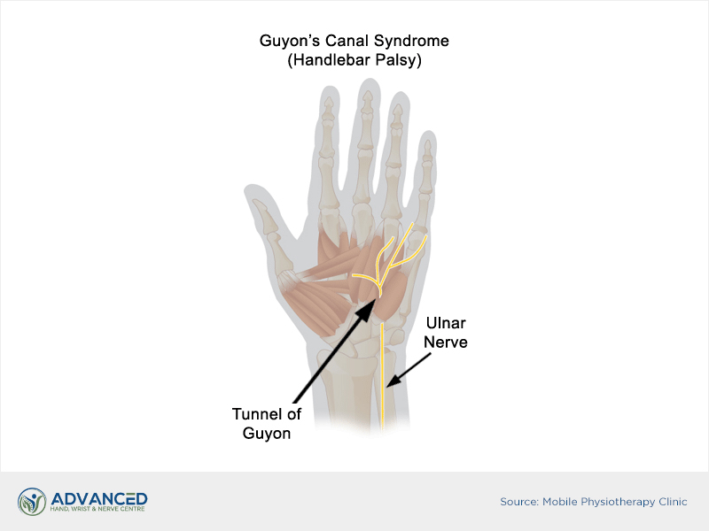 Infographics showing Guyon's canal syndrome