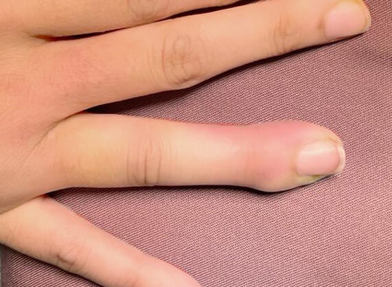 Surgery for Hand Infections Singapore