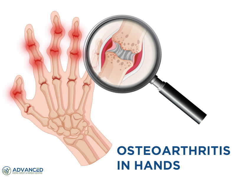 Osteoarthritis in Hands