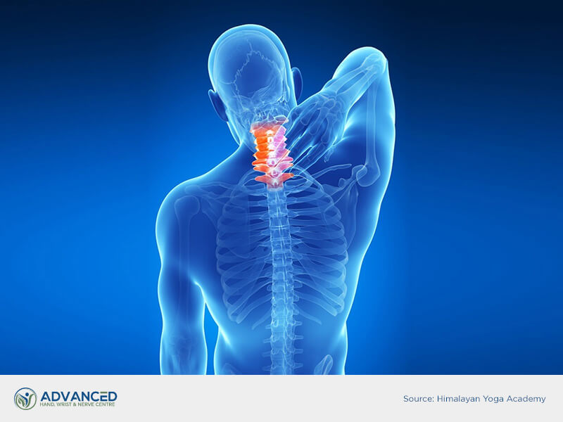 cervical spondylosis