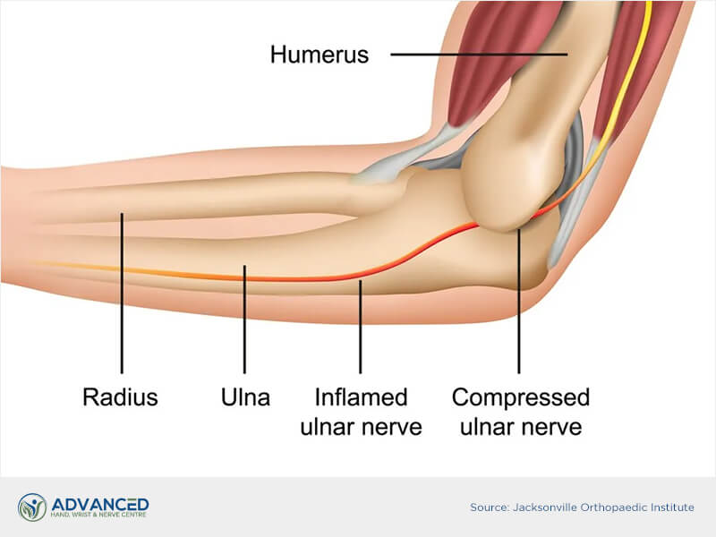 Infographics showing Cubital Tunnel Syndrome
