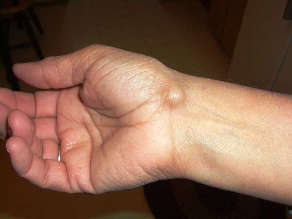 Ganglion Cysts Singapore