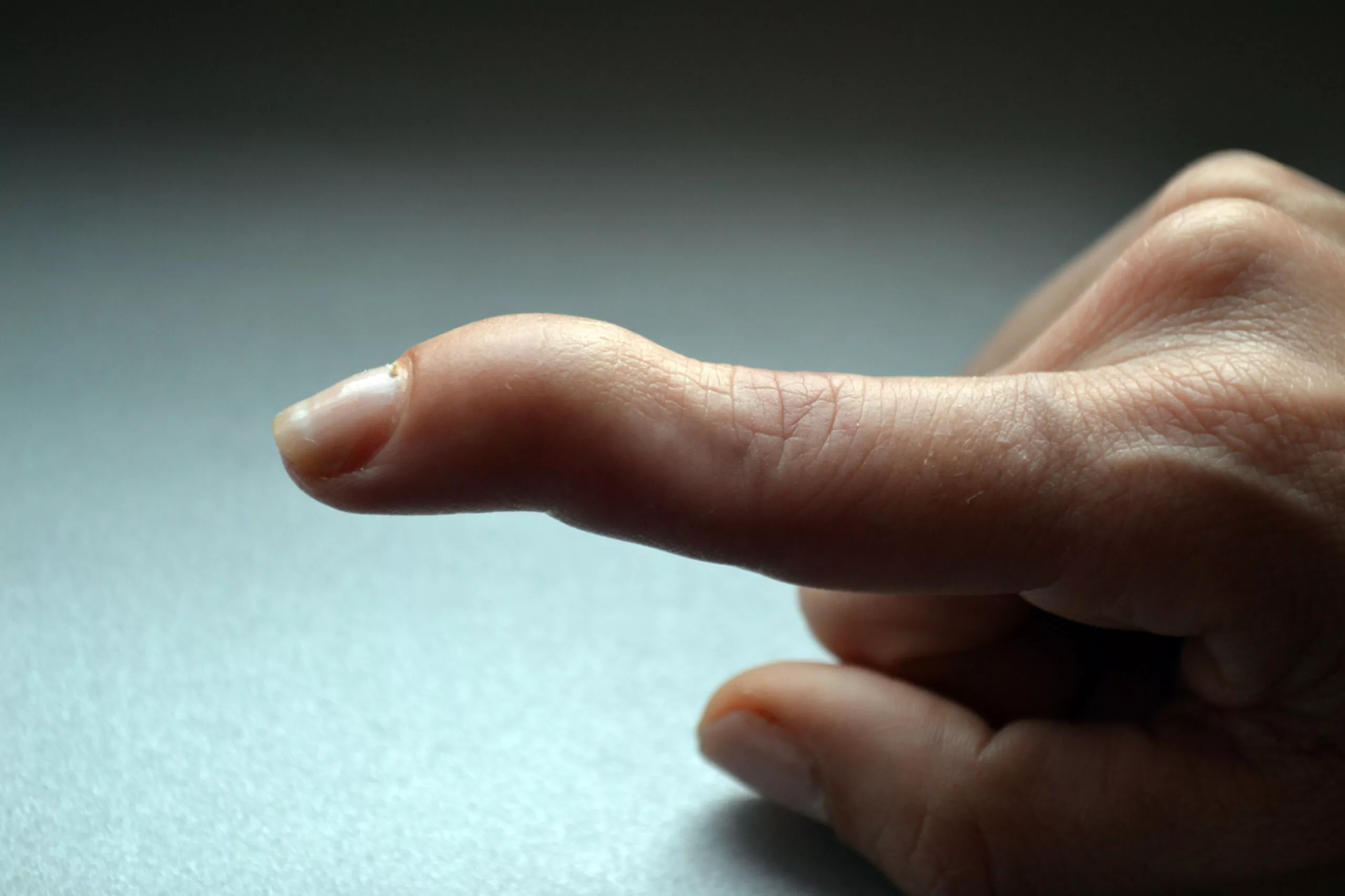 Upper Limb Injuries: Mallet Finger, Tendon & Nerve Singapore