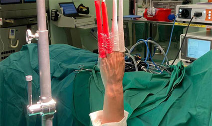 Wrist Arthroscopy & Wrist Pain Singapore