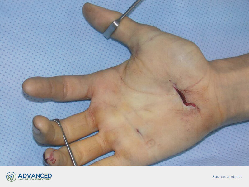 peripheral nerve injury