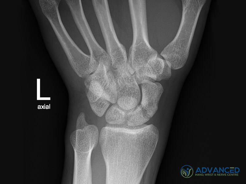 Xray with wrist injury