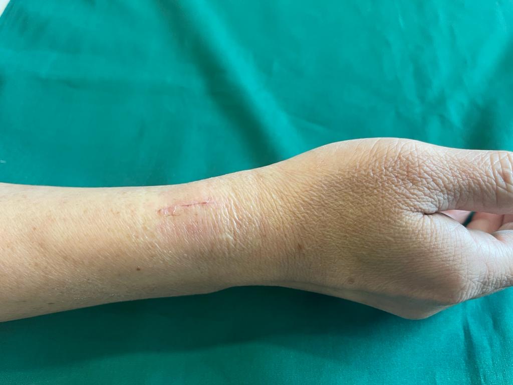 older asian lady experiencing DeQuervain’s Tenosynovitis in Singapore