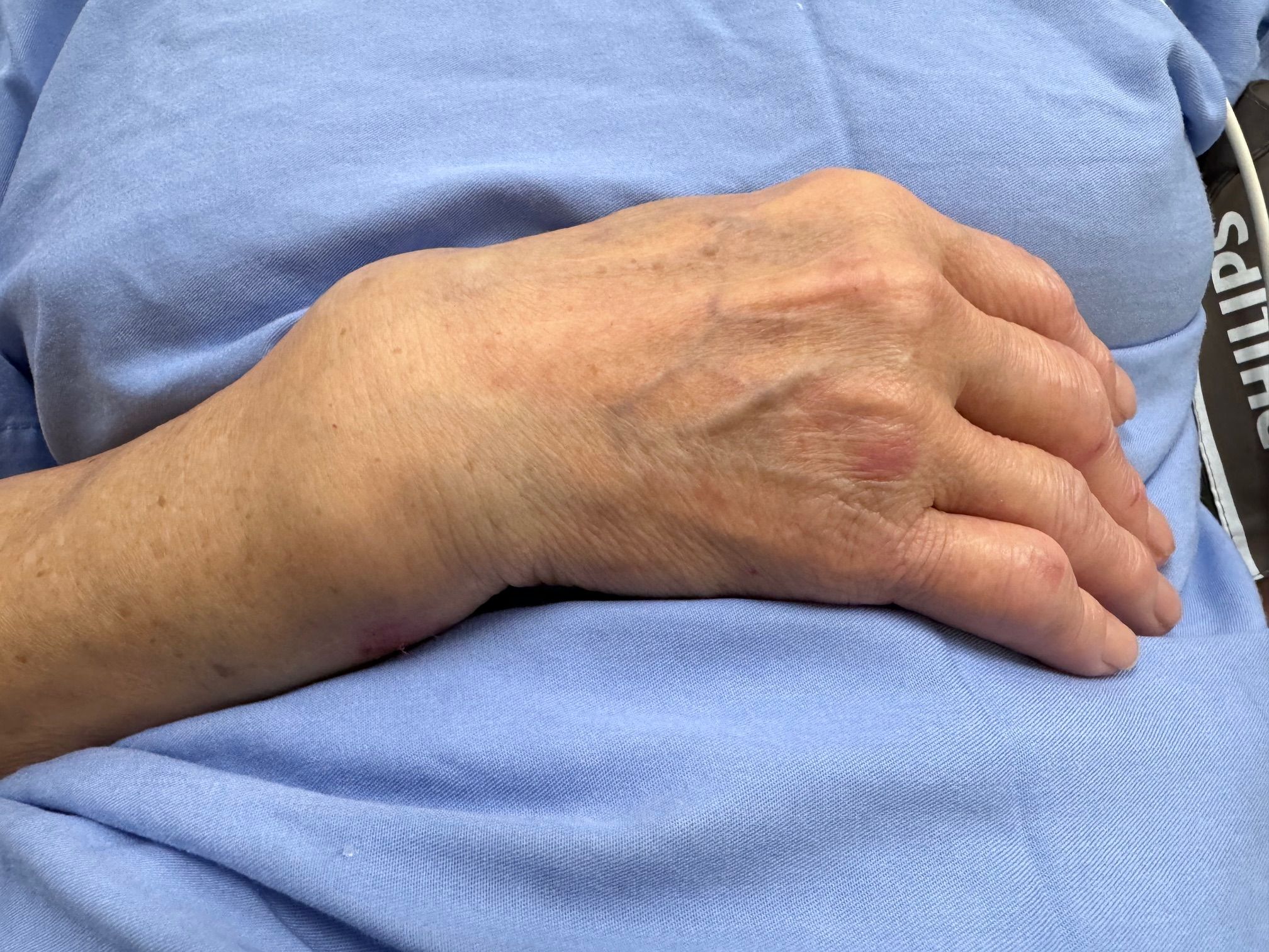 Distal Radius Fractures Singapore