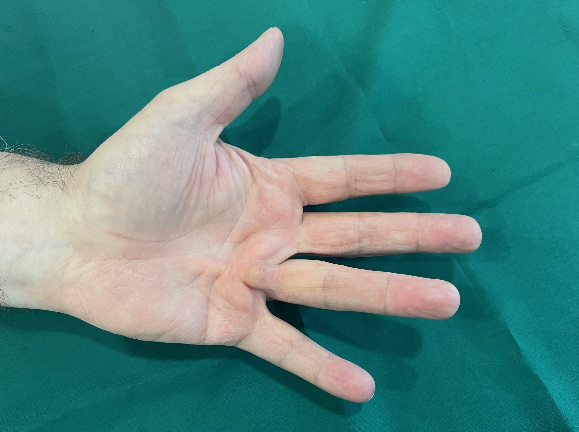 Dupuytren's Contracture Singapore