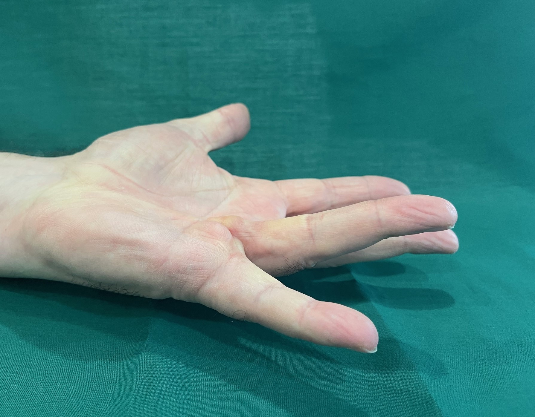 Dupuytren's Contracture Singapore