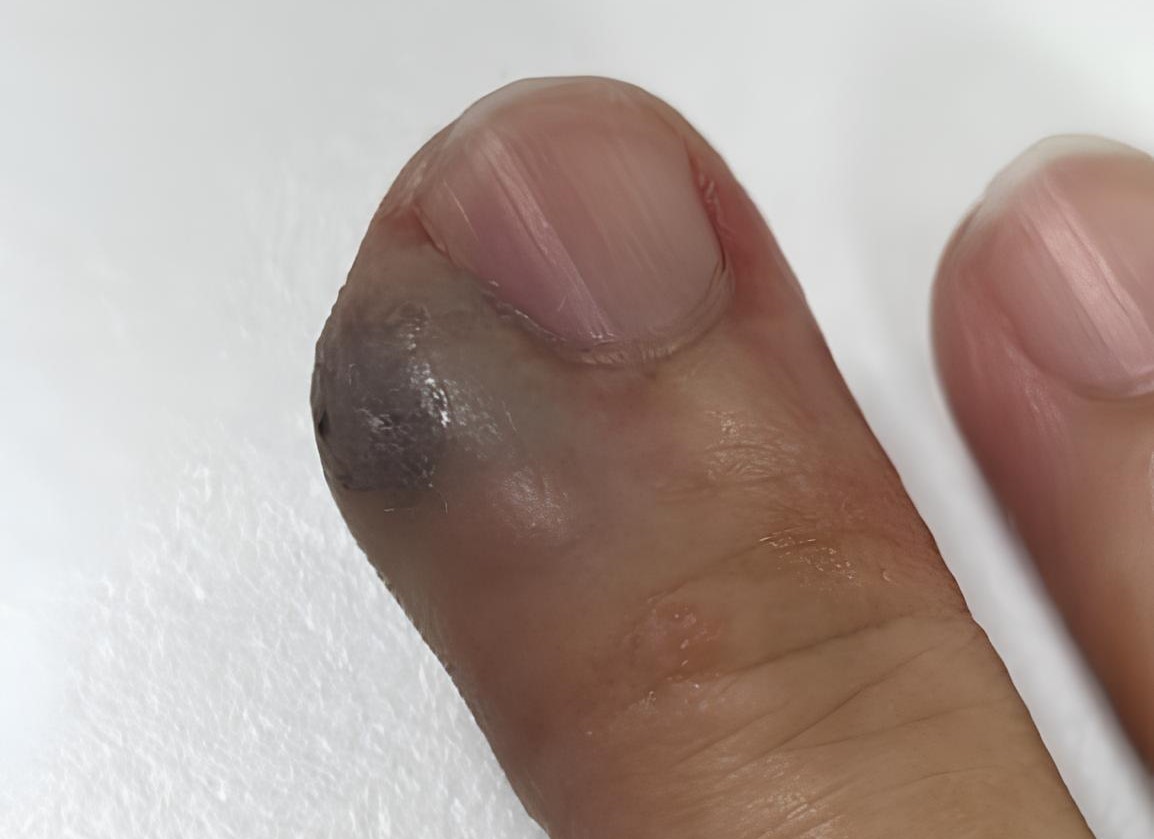 Hand Infections Singapore