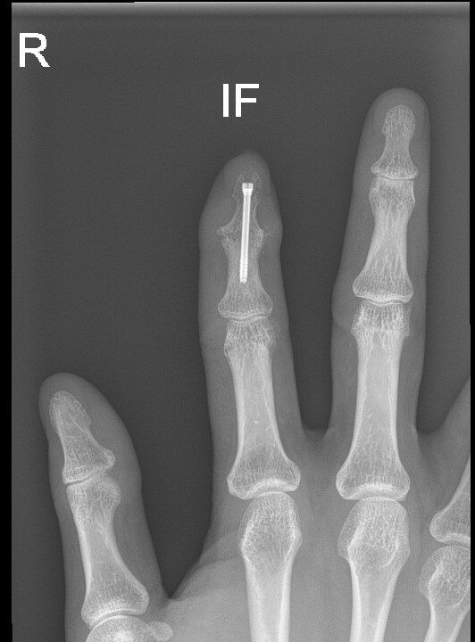 Joint Fusion & Joint Replacement Singapore