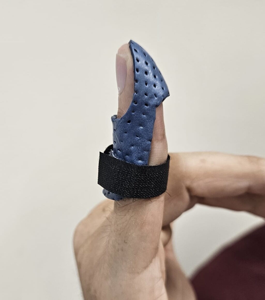 Upper Limb Injuries: Mallet Finger, Tendon & Nerve Singapore