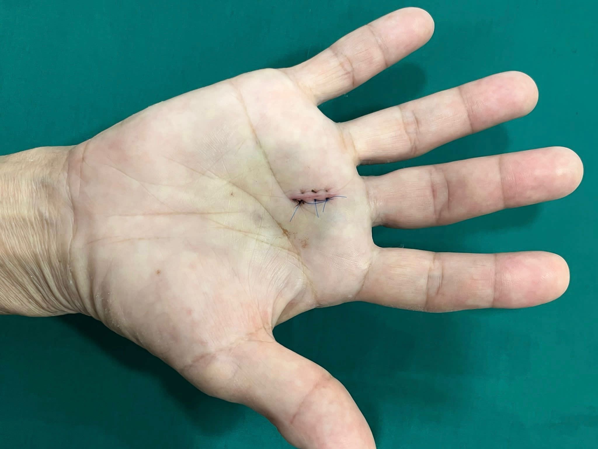 Trigger Finger Surgery Singapore