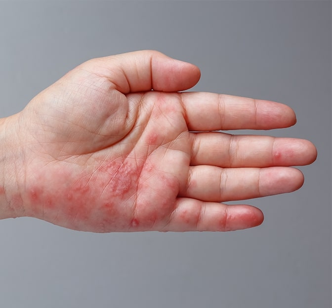 Hand Infections Singapore