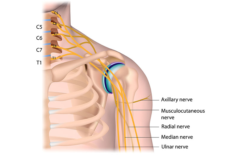 Brachial Plexus Injuries Singapore