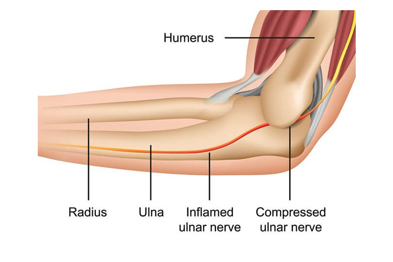 medical illustration of Cubital Tunnel Syndrome in Singapore