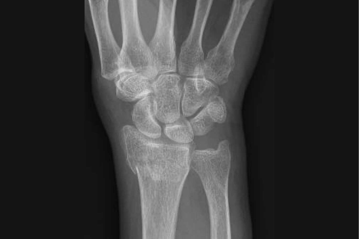 Distal Radius Fractures Singapore