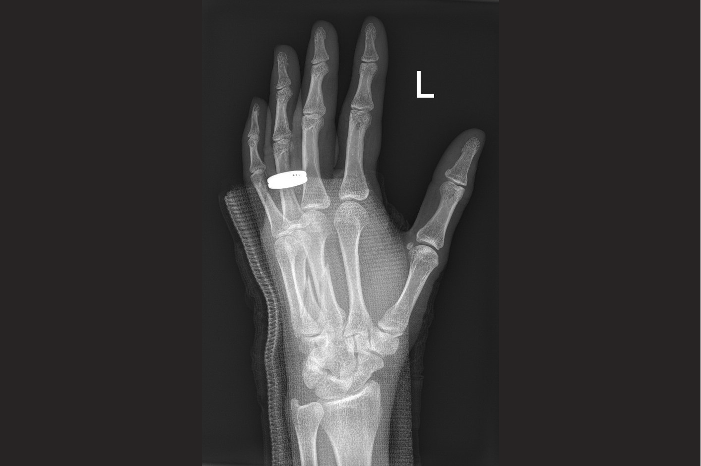 Hand Fractures Singapore