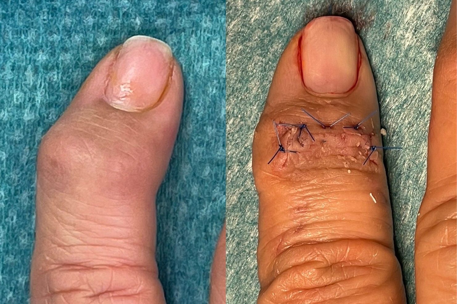 Joint Fusion & Joint Replacement Singapore
